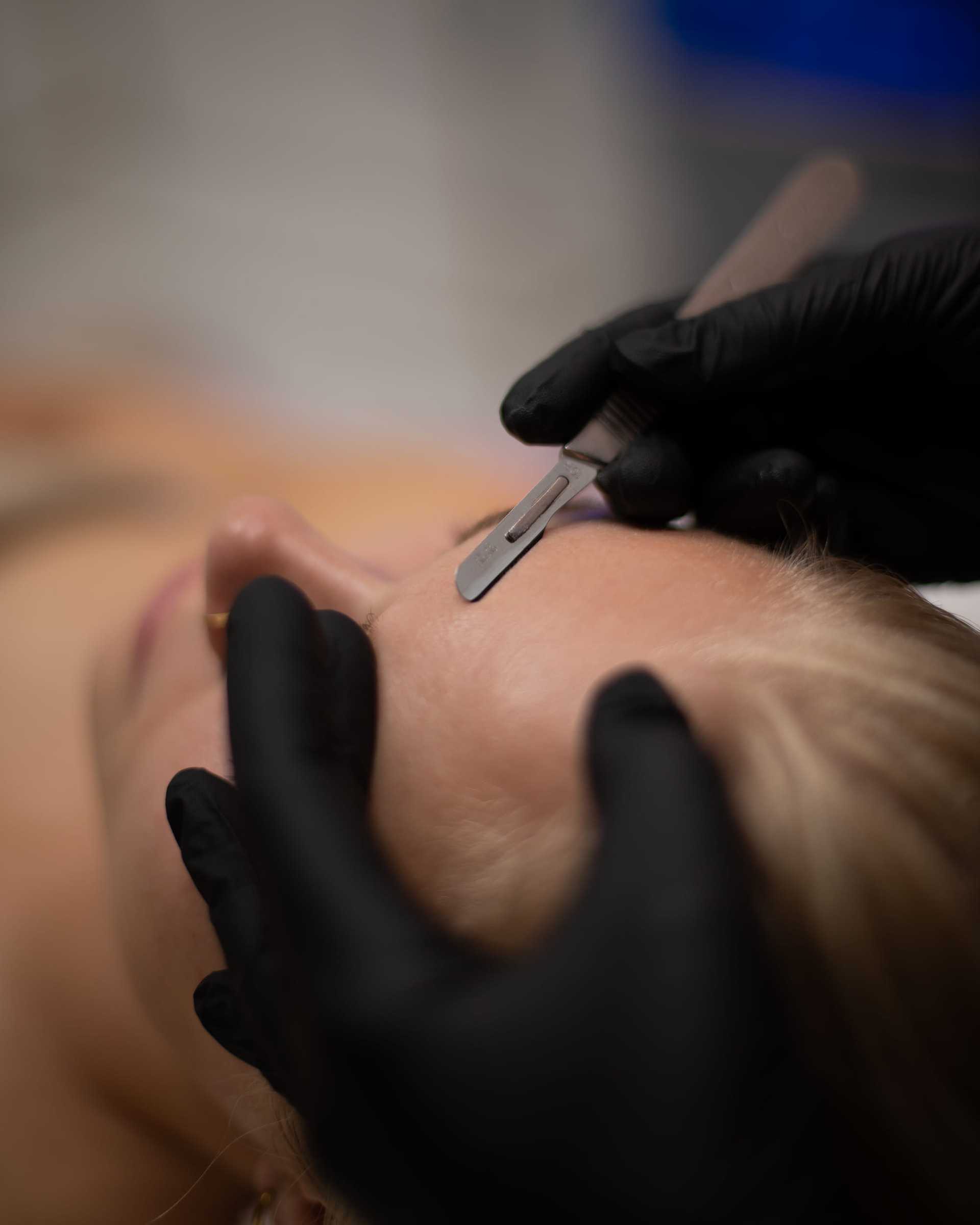 Dermaplaning procedure on a person's forehead by a professional in black gloves.